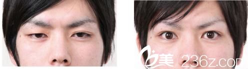 眼睑下垂修正 眼睑下垂修正