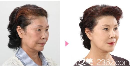 竹内式面部拉皮 W-SMAS 竹内式面部拉皮 W-SMAS