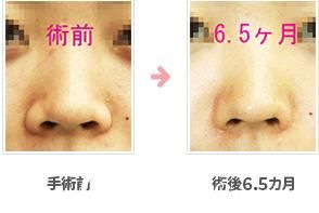 鼻翼缩小术 鼻翼缩小术