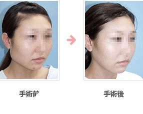 腮帮整形 腮帮整形