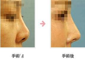 鼻中隔延长 鼻中隔延长