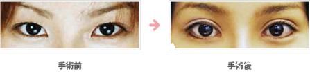 全切双眼皮 全切双眼皮