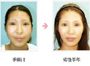 颊骨削.jpg 削颊骨 颊骨削.jpg 削颊骨