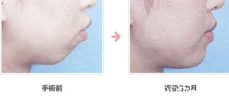 下巴植入假体 下巴植入假体