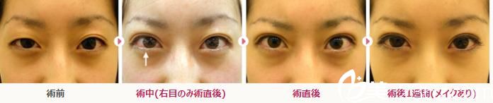 不肿的埋设法双眼皮 不肿的埋设法双眼皮