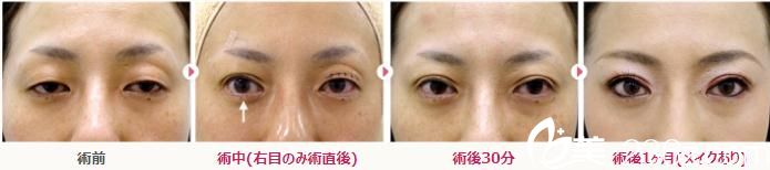 不开刀治疗眼睑下垂 不开刀治疗眼睑下垂