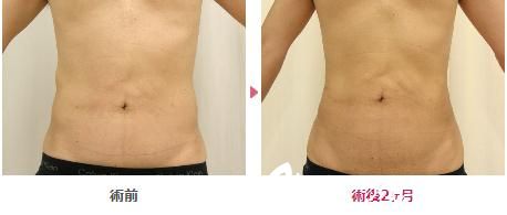 真崎式吸脂 真崎式吸脂