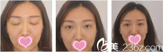 韩国天鹅swan整形医院黄成浩眼修复真人案例术前照 韩国天鹅swan整形医院黄成浩眼修复真人案例术前照