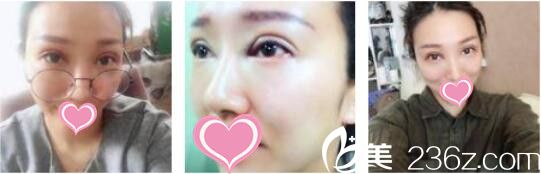 韩国天鹅swan整形医院黄成浩眼修复真人案例术后第五天 韩国天鹅swan整形医院黄成浩眼修复真人案例术后第五天