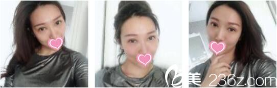 韩国天鹅swan整形医院黄成浩眼修复真人案例术后十五天