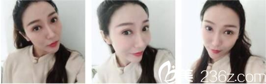 韩国天鹅swan整形医院黄成浩眼修复真人案例术后一个月