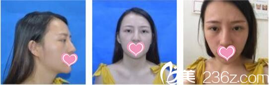 韩国天鹅swan整形医院黄成浩鼻综合+自体脂肪面部填充真人案例术前照 韩国天鹅swan整形医院黄成浩鼻综合+自体脂肪面部填充真人案例术前照