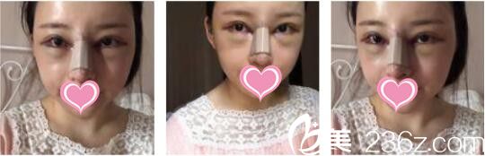 韩国天鹅swan整形医院黄成浩鼻综合+自体脂肪面部填充真人案例术后第二天 韩国天鹅swan整形医院黄成浩鼻综合+自体脂肪面部填充真人案例术后第二天