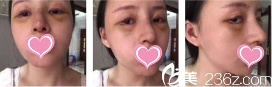 韩国天鹅swan整形医院黄成浩鼻综合+自体脂肪面部填充真人案例术后第七天 韩国天鹅swan整形医院黄成浩鼻综合+自体脂肪面部填充真人案例术后第七天