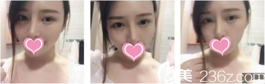 韩国天鹅swan整形医院黄成浩鼻综合+自体脂肪面部填充真人案例术后二十一天 韩国天鹅swan整形医院黄成浩鼻综合+自体脂肪面部填充真人案例术后二十一天