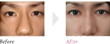 鼻骨缩小术 鼻骨缩小术