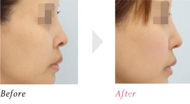 鼻孔上缘下降术 鼻孔上缘下降术