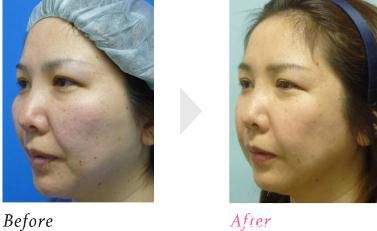 颊骨削除 颊骨削除