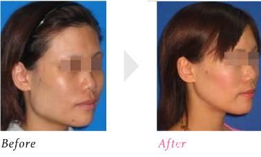 下颚角形成 下颚角形成