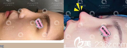 合肥安妮薇尔李继银肋软骨鼻综合案例 合肥安妮薇尔李继银肋软骨鼻综合案例