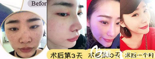 田军达拉斯隆鼻术后恢复过程图 田军达拉斯隆鼻术后恢复过程图