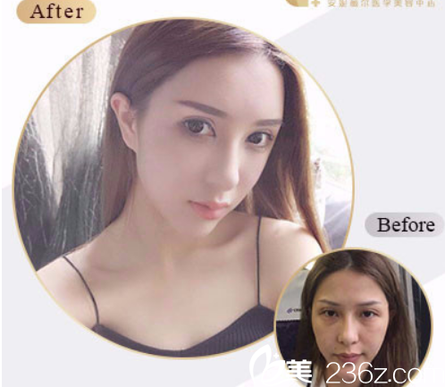 程林军自体脂肪全脸填充案例 程林军自体脂肪全脸填充案例