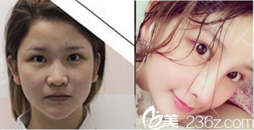 李秋艳玻尿酸除皱填充面部年轻化案例前后效果对比 李秋艳玻尿酸除皱填充面部年轻化案例前后效果对比