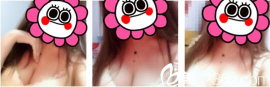 韩国天鹅swan整形医院黄成浩自体脂肪隆胸真人案例术后十八天 韩国天鹅swan整形医院黄成浩自体脂肪隆胸真人案例术后十八天