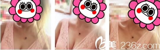 韩国天鹅swan整形医院黄成浩自体脂肪隆胸真人案例术后一个月 韩国天鹅swan整形医院黄成浩自体脂肪隆胸真人案例术后一个月