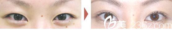 双眼皮手术