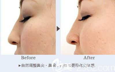 注射玻尿酸 注射玻尿酸