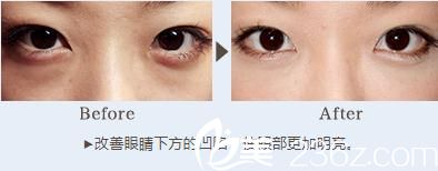 对鼻子和眼睛下方玻尿酸注射 对鼻子和眼睛下方玻尿酸注射