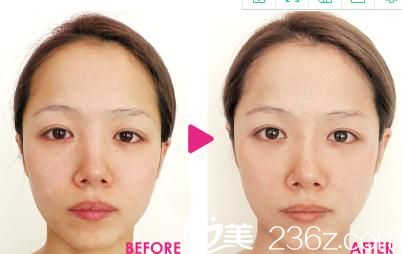 Dr.衣理式TrueLift立提注射 Dr.衣理式TrueLift立提注射