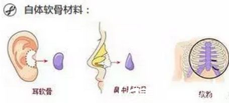 自体软骨的材料来源