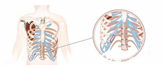 肋软骨的取材位置