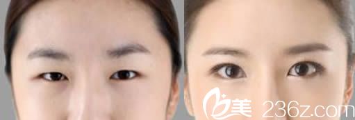 楚雄现代韩式无痕双眼皮案例效果对比图