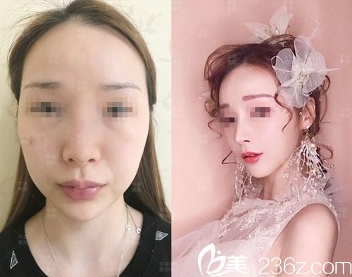 付国友隆鼻真人案例