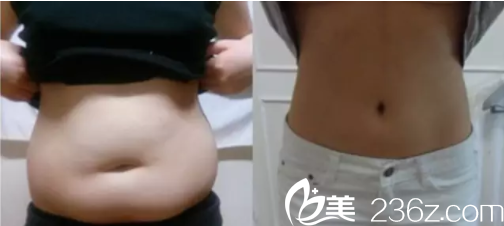 <!--<i data=20240703-sp></li>
<li><i data=20240703-sp></i>-->安波腰腹抽吸脂案例