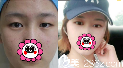 <!--<i data=20240703-sp></li>
<li><i data=20240703-sp></i>-->张建宾埋线双眼皮案例