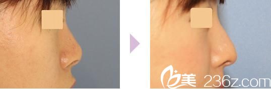 鼻中隔延长 鼻中隔延长