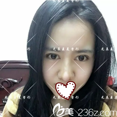 4D鼻综合术后一周拆线 4D鼻综合术后一周拆线