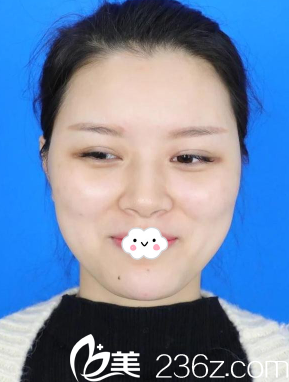 <!--<i data=20240703-sp></i>-->陈茂年硅胶假体隆鼻综合整形真人<span style= <!--<i data=20240703-sp></i>-->陈茂年硅胶假体隆鼻综合整形真人<span style=