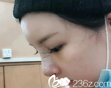 <!--<i data=20240703-sp></i>-->隆鼻整形怎么样?陈茂年鼻综合整形术后<span style= <!--<i data=20240703-sp></i>-->隆鼻整形怎么样?陈茂年鼻综合整形术后<span style=