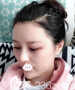 <!--<i data=20240703-sp></i>-->陈茂年硅胶假体隆鼻综合整形术后<span style= <!--<i data=20240703-sp></i>-->陈茂年硅胶假体隆鼻综合整形术后<span style=