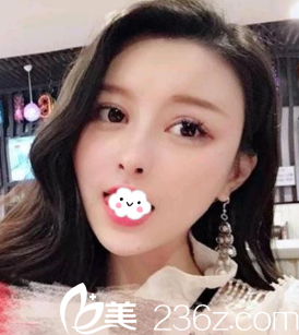 朋友在割双眼皮效果挺好,让我找陈茂年做硅胶假体隆鼻综合整形