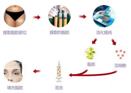 美立方(大华)整形医院采用纯自体脂肪填充术 美立方(大华)整形医院采用纯自体脂肪填充术