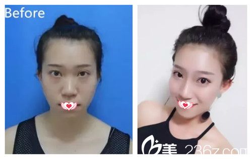 张家口维多利亚注射玻尿酸案例