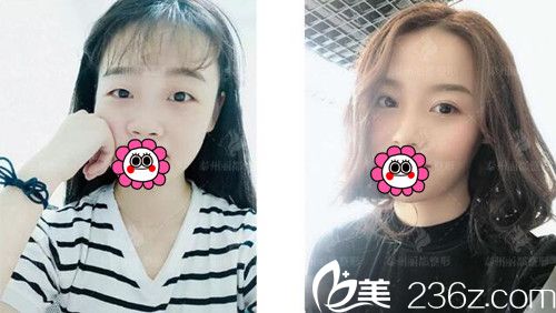 泰州丽都整形双眼皮案例 泰州丽都整形双眼皮案例