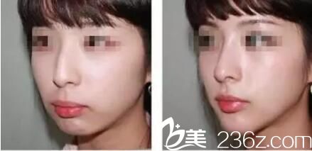 泰州丽都整形隆鼻案例 泰州丽都整形隆鼻案例