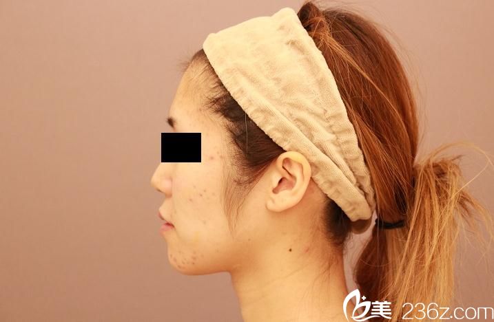 脸部脂肪填充前